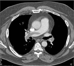 Pulmonary Embolism - CTisus CT Scan