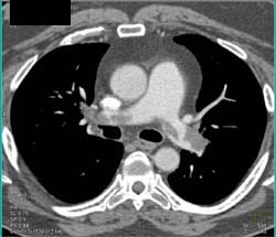 Pulmonary Embolism - CTisus CT Scan