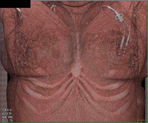 Lung Cancer Metastatic to Subcutaneous Tissue - CTisus CT Scan