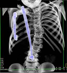 Chest Wall Reconstruction With Hardware - CTisus CT Scan