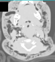 Pneumomediastinum and Pneumothorax and Air Into the Neck - CTisus CT Scan