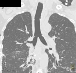 Stent in Trachea - CTisus CT Scan