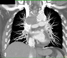 Occlusion SVC With Collaterals and Azygos Enlargement - CTisus CT Scan