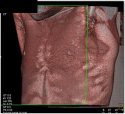 Lipoma in Left Chest Wall - CTisus CT Scan