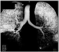 Virtual Bronchoscopy With Bronchiectasis - CTisus CT Scan