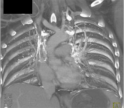 SVC Occlusionwith Mediastinal Collaterals - CTisus CT Scan