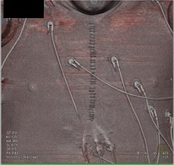 Post Chest Wall Surgery - CTisus CT Scan