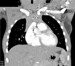 Normal Thymus and Lipoma in Left Axilla - CTisus CT Scan