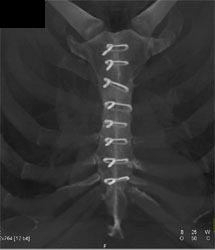 Post Medial Sternotomy - CTisus CT Scan