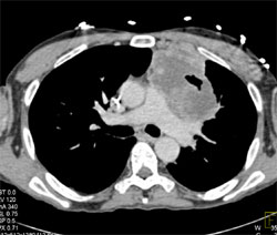 Necrotic Mediastinal Tumor - CTisus CT Scan