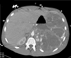 Extensive Mucinous Tumor in Left Chest and Plueral Space - CTisus CT Scan