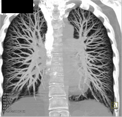 Normal MIP of the Lung - CTisus CT Scan