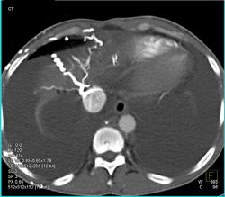 Scv Syndrome With Collaterals Through and Into IVC - CTisus CT Scan