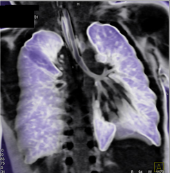 Wegener's of the Airway - CTisus CT Scan