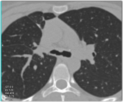 Thickening of Airway Due to Wegener's - CTisus CT Scan