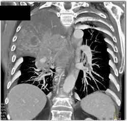 Left Upper Lobe Encased By NSCLC With Extensive Nodes - CTisus CT Scan