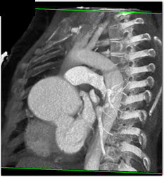 Dilated Aortic Root - CTisus CT Scan