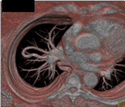 Pulmonary Arteriovenous Malformation (PAVM) - CTisus CT Scan