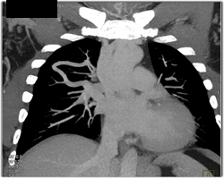 Pulmonary Arteriovenous Malformation (PAVM) - CTisus CT Scan