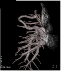 Pulmonary Arteriovenous Malformation (PAVM) - CTisus CT Scan