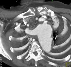 Aberrant Right Subclavian With Aneurysm - CTisus CT Scan