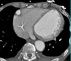 Right Coronary Aneurysm - CTisus CT Scan