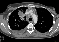 Mai Infection With Cystic Nodes - CTisus CT Scan