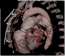 Post Repair of Aortic Aneurysm - CTisus CT Scan