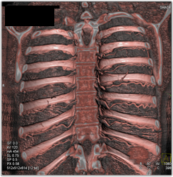 Normal Intercostal Arteries Using Various Lighting Models - CTisus CT Scan