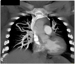 Pulmonary Arteriovenous Malformation (PAVM) - CTisus CT Scan