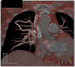 Pulmonary Arteriovenous Malformation (PAVM) - CTisus CT Scan