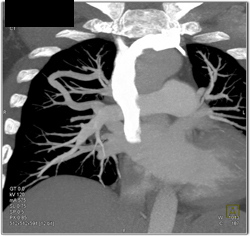 Pulmonary Arteriovenous Malformation (PAVM) - CTisus CT Scan