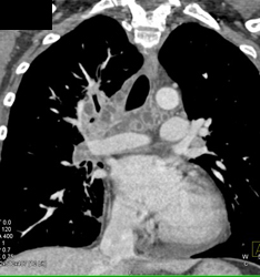 Cystic Nodes Due to Tuberculosis (TB) - CTisus CT Scan