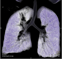 Normal Virtual Bronchoscopy - CTisus CT Scan