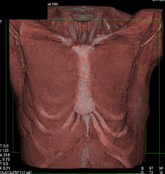 Reconstruction Following Resection of A Chest Wall Tumor - CTisus CT Scan