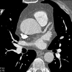 Dilated Aortic Root - CTisus CT Scan