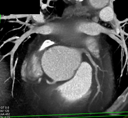 Dilated Aortic Root - CTisus CT Scan