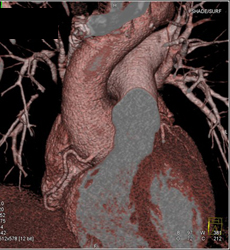 Dilated Aortic Root - CTisus CT Scan