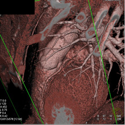 Dilated Aortic Root - CTisus CT Scan