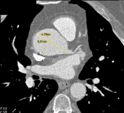 Dilated Aortic Root - CTisus CT Scan