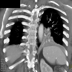 Stenosis Left Mainstem Bronchus and Occlusion Left Lower Lobe Bronchus - CTisus CT Scan