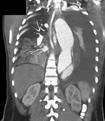 Aortic Dissection With Intramural Blood - CTisus CT Scan