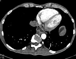 Pe - CTisus CT Scan