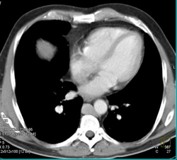 Dilated Azygos With Azygos Continuation of the IVC - CTisus CT Scan