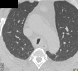 Amyloid of the Trachea - CTisus CT Scan