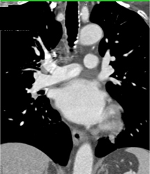 Subtle Lesion Right Wall Trachea - CTisus CT Scan