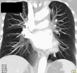 SVC With High Density Contrast - CTisus CT Scan