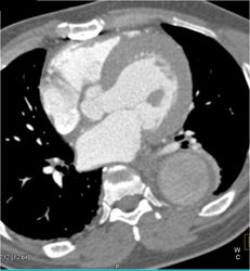 Aortic Aneurysm With Dissection and Compressed True Lumen - CTisus CT Scan