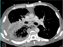 Stent in Esophageal Cancer With Fistulae to Lung - CTisus CT Scan