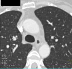 Prominent Right Upper Lobe Bronchi - CTisus CT Scan